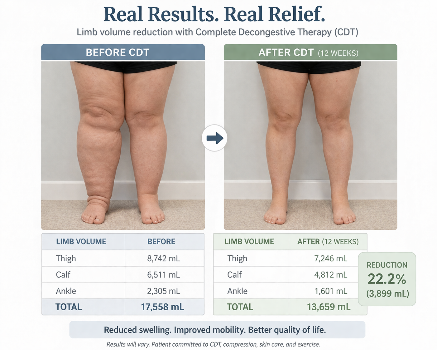 Before and after limb volume reduction results from CDT treatment by Certified Lymphedema Therapist in Northern Virginia
