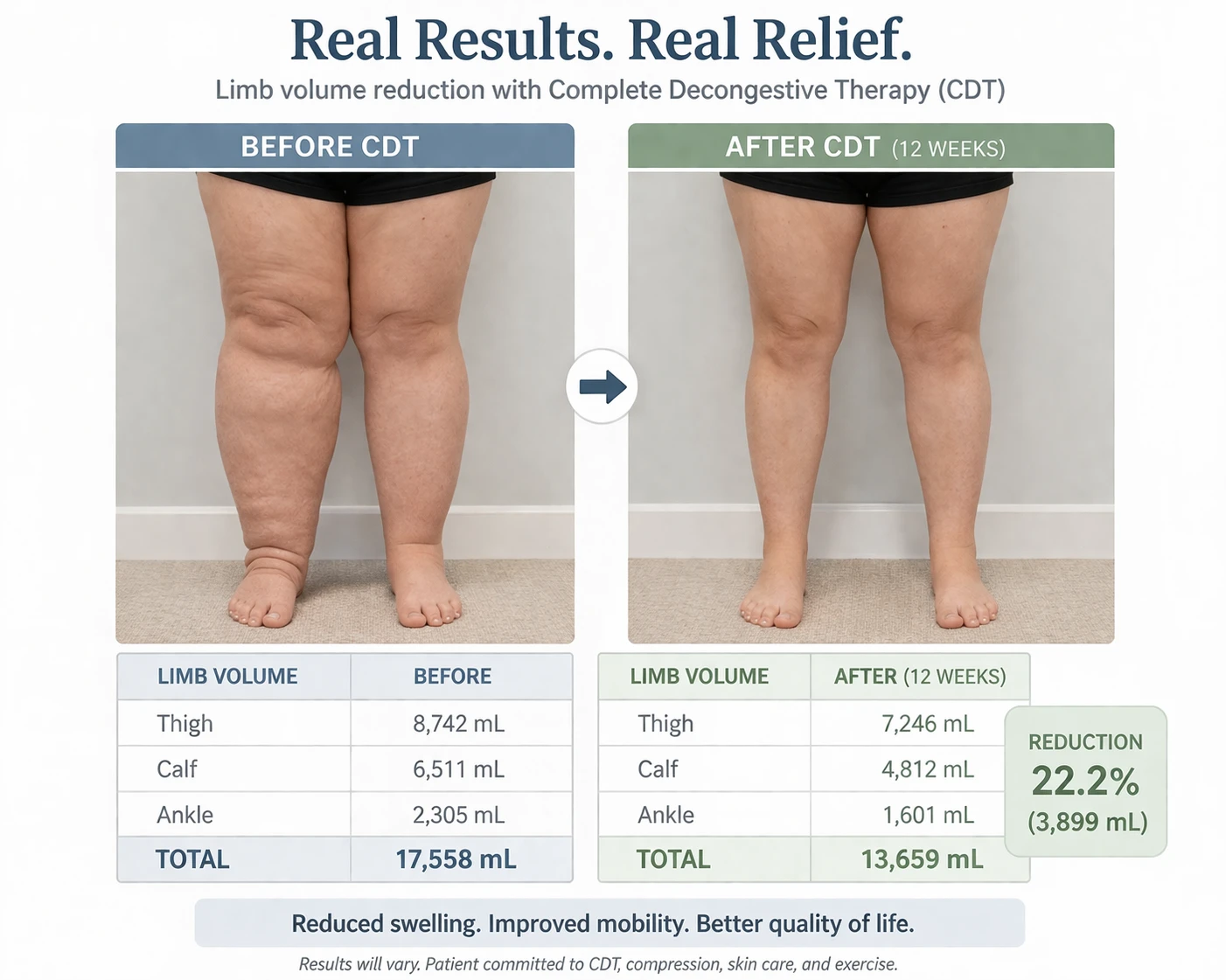Before and after limb volume reduction results from CDT treatment by Certified Lymphedema Therapist in Northern Virginia